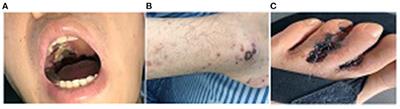 Eosinophilic Granulomatosis With Polyangiitis Presenting With Oral Granuloma as the Initial Symptom: A Case Report